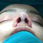 Rhinoplasty Techniques Using PTFE For Tip Augmentation Are Sometimes Referred To As A Korean-style Rhinoplasty