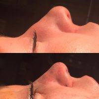 Rhinoplasty To Correct A Bulbous, Rounded Nasal Tip