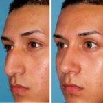 Roman Nose Job Before After (4)