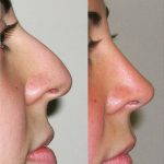 Septoplasty Photo Before And After (3)