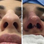 Septoplasty Straightens The Septum, Allowing For Better Airflow Through Your Nose