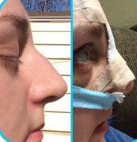 Septorhinoplasty Procedure Before And After