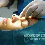 Skin Grafts May Also Be Necessary For Augmentation Rhinoplasty