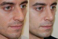 Straightening Of Nose And Profile Refinement By Eric M. Joseph