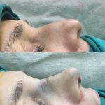 Surgery For Bulbous Nose Before And After (1)
