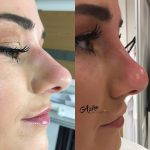 Surgery For Bulbous Nose Before And After (2)