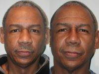 Surgical Rhinoplasty For African American Man