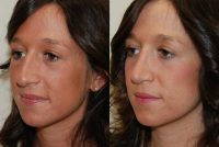 Tip Narrowing, Nasal Shortening, And Profile Refinement