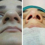 What Does A Bulbous Nose Job Look Like