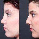 What Is A Nose Augmentation Photo