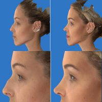 With Rhinoplasty Simulator App You Can See What Your Ideal Nose May Look Like