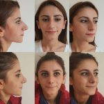 amazing before and after nose jobs