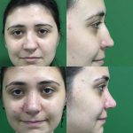 amazing before and after nose jobs (2)