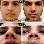 amazing before and after nose jobs (7)