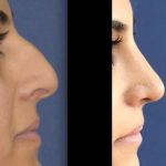 before and after a nose job photos (4)