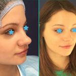 before and after bulbous nose rhinoplasty