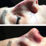before and after long nose jobs (4)