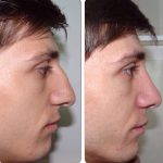 before and after nose contouring (1)