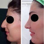 before and after nose contouring (4)