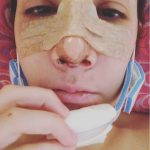 before and after nose job bulbous (1)
