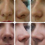 before and after nose job images (2)
