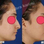before and after nose job images (3)