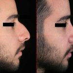 before and after nose job male pic