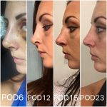 before and after nose job pictures (6)