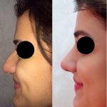 before and after nose plastic surgery