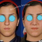 before and after nose plastic surgery (4)