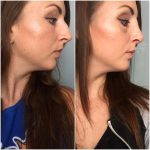 before and after pictures of a nose job (1)