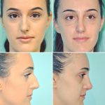 before and after pictures of nose reshaping