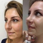 best before and after nose jobs (4)