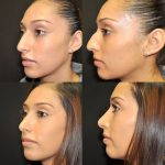 Before After Hooked Nose Job (3)