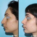 Before And After Hooked Nose Fix (2)