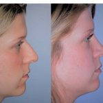 Before And After Hooked Nose Fix (3)