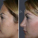 Before And After Hooked Nose Fix (4)