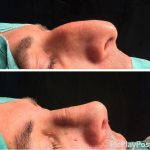 Before And After Nose Bump Correction (4)