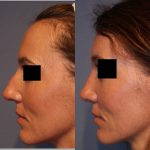 Before And After Nose Bump Surgery (1)