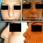 Before And After Nose Bump Surgery (2)