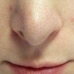Big Bulbous Nose Before And After (12)