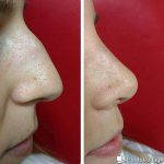 Big Bulbous Nose Before And After (5)