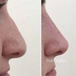 Big Nose Before And After (2)