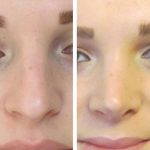 Big Nose Before And After (4)