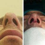 Big Nose Job Before And After Pictures (4)