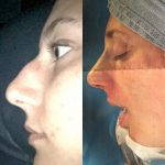 Big Nose Rhinoplasty Can Be Used To Treat A Long Nose By Repositioning Or Trimming The Tip Cartilages