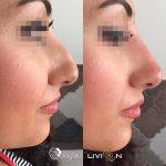 Can Rhinoplasty Fix A Big Nose Photo (4)