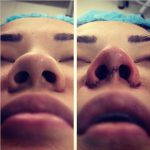 Deviated Septum Before And After Photos (7)