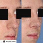 Deviated Septum Before And After Photos (8)