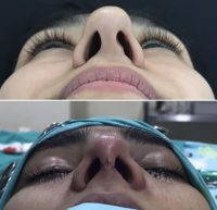 Deviated Septum Surgery Is Done In Order To Improve Airflow Through Your Nose